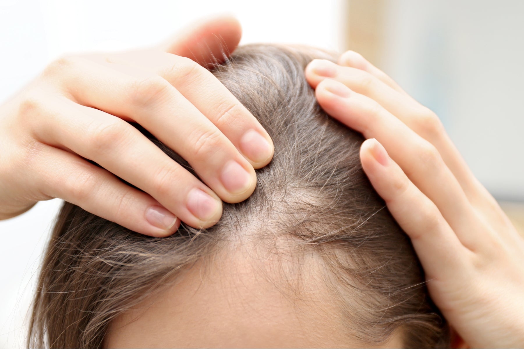 Caída capilar y afinamiento: por qué el tiempo importa para el diagnóstico